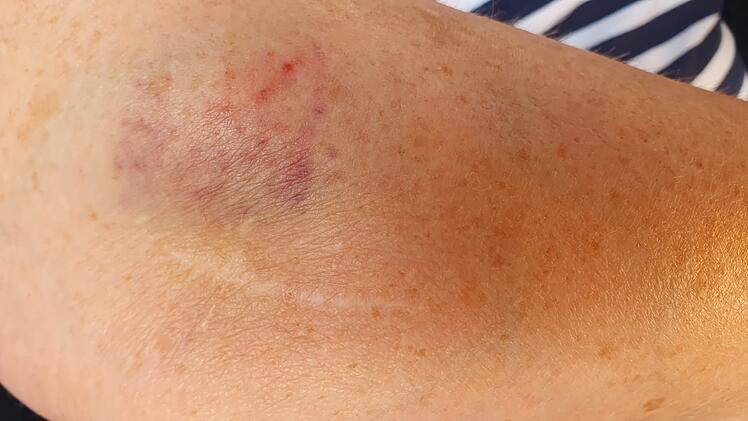 Neustadt bei Coburg: Mitarbeiterin schildert wilde Beißattacke durch Ladendiebin - "kaum zu bändigen"