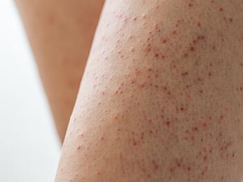 Keratosis pilaris an den Beinen einer jungen Frau. Haut mit roten Flecken