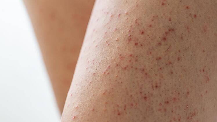 Keratosis pilaris an den Beinen einer jungen Frau. Haut mit roten Flecken