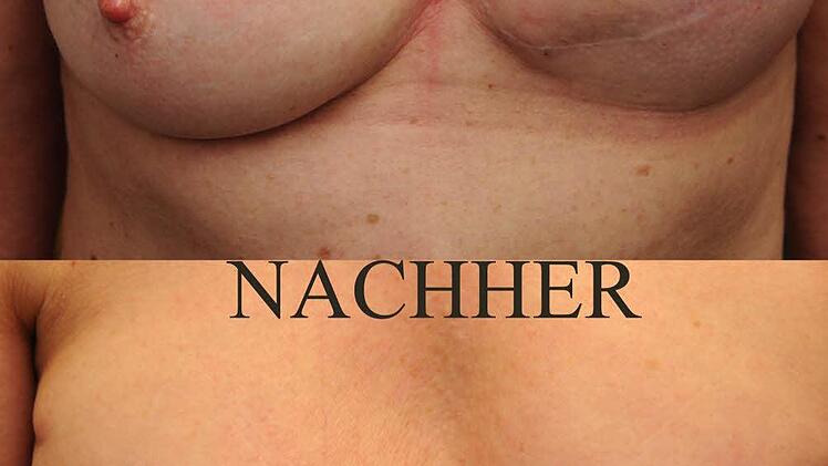 Vorher - nachher: Andy Engel gelingt mit seinen 3D-Tattoos die täuschend echte Rekonstruktion einer Brustwarze .  Foto: Engel/Archiv