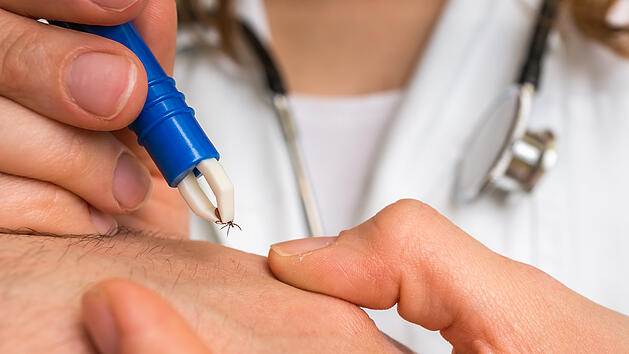 Zeckenzange, Zecke entfernen