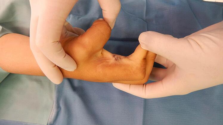 Von der geschlossenen zur wieder funktionsfähigen Hand  Foto: Klinikum Kulmbach