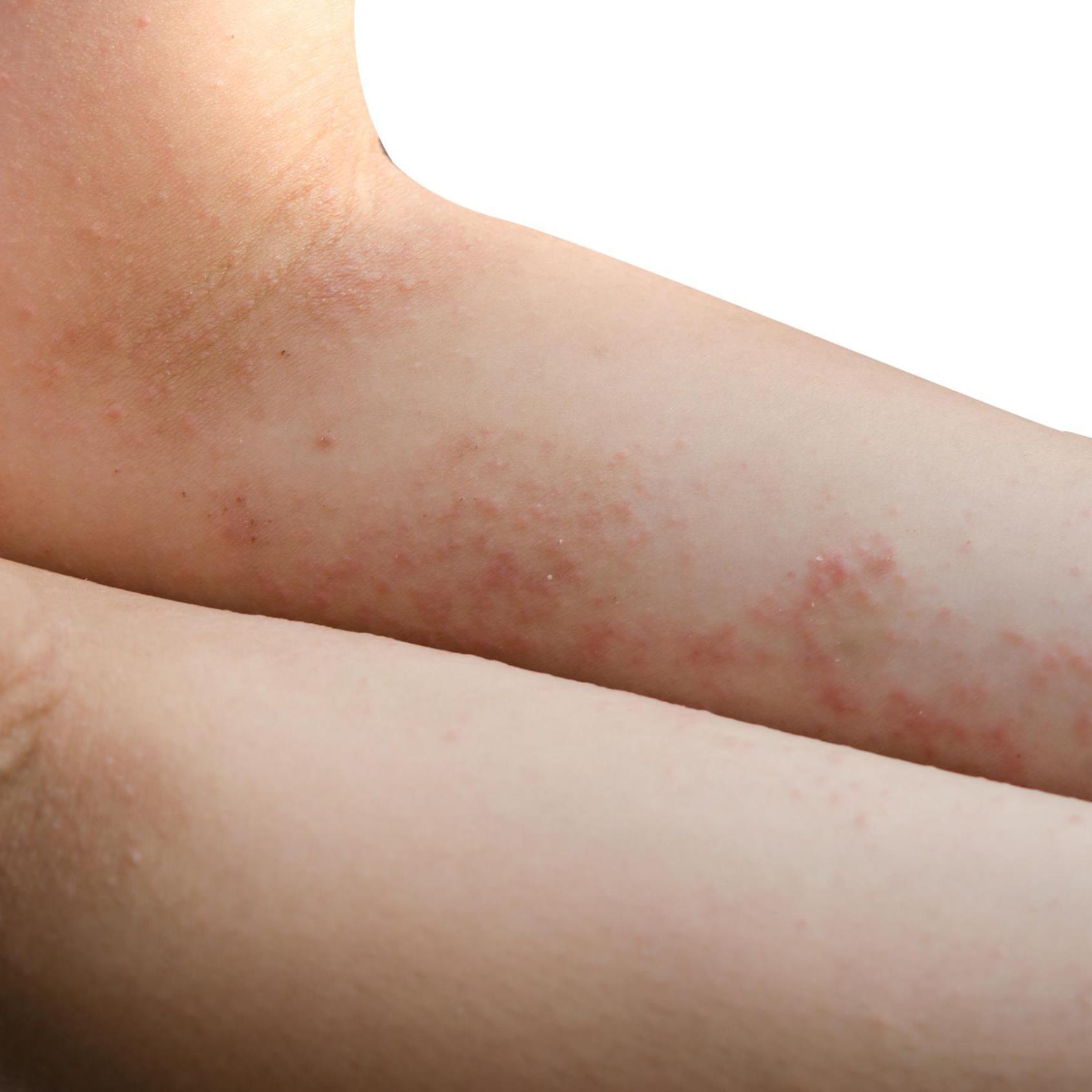 erste Anzeichen von Krätze