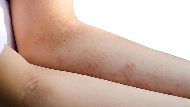 Krätze bricht immer wieder aus. Doch heute lässt sich die lästige Hautinfektion gut behandeln.  Foto: Thinkstock