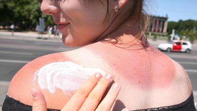 Eine Frau bekommt den Sonnenbrand mit Sonnencreme eingecremt. Mit der Sonne kommt auch die Sonnenbrandgefahr. Foto: Stephanie Pilick/dpa