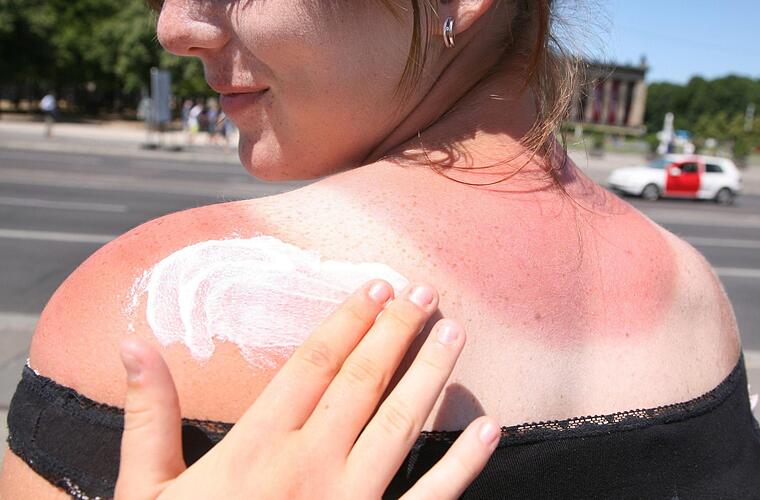 Was tun bei Sonnenbrand? Diese Mittel helfen, wenn die Haut schmerzt