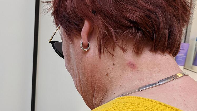 Auch am Hals wurde die Urlauberin getroffen.