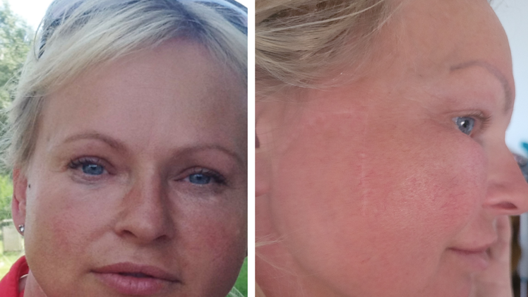 N&uuml;rnbergerin entdeckt nur dank ihrer Chefin gef&auml;hrlichen Hautkrebs bei sich