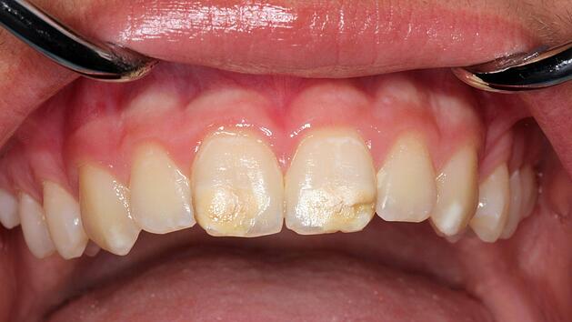 Raue und zerfurchte Zahnoberfl&auml;chen: Zahn&auml;rzte warnen aktuell vor "Kreidez&auml;hnen" bei Kindern. Sie sprechen sogar von einer neuen Volkskrankheit. Foto: Prof. Dr. Norbert Kr&auml;mer/dpa