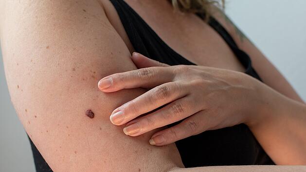 Frau, die ihre Haut auf ein abnormales Muttermal untersucht, um Anzeichen für Melanom-Hautkrebs zu erkennen, Dermatoskopie, Prävention von Melanomen, Hautkrebs