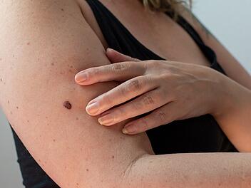 Frau, die ihre Haut auf ein abnormales Muttermal untersucht, um Anzeichen für Melanom-Hautkrebs zu erkennen, Dermatoskopie, Prävention von Melanomen, Hautkrebs