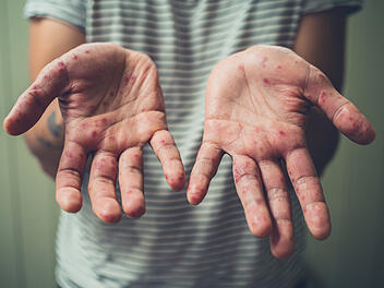 Hand-Mund-Fuß-Krankheit