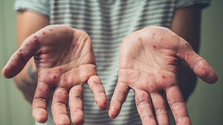 Hand-Mund-Fuß-Krankheit