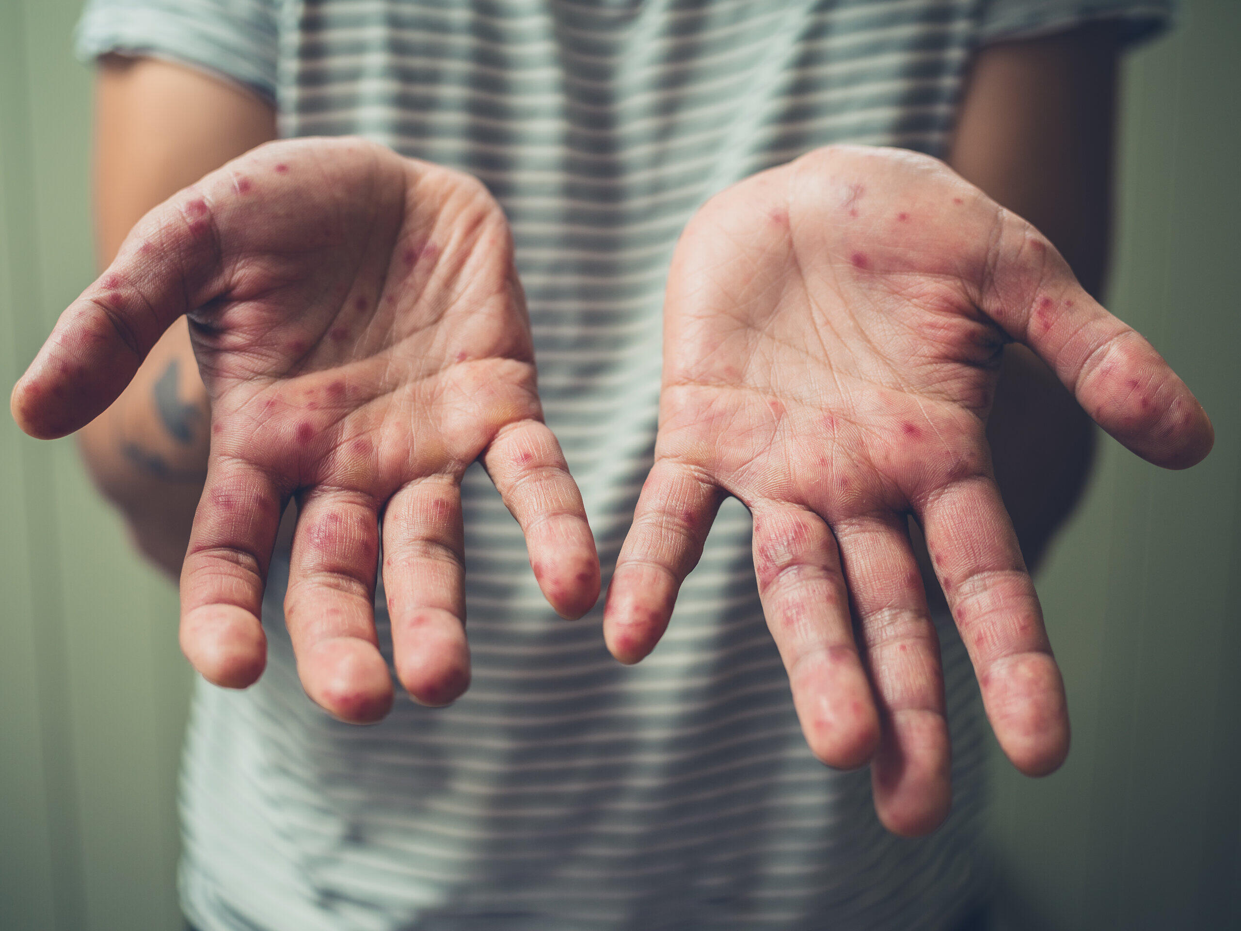 HandFußMundKrankheit Auch Erwachsene können erkranken HandFußMundKrankheit Auch Erwachsene können erkranken