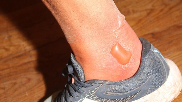 Dicke Blasen von den Socken konnten Doris B&ouml;ckler nicht davon abhalten, die Strecke bis zum Schluss durchzuwandern. Foto: Sonny Adam