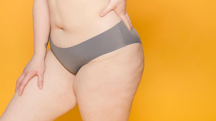 Cellulite kann ein Anzeichen für ein Lipödem sein.