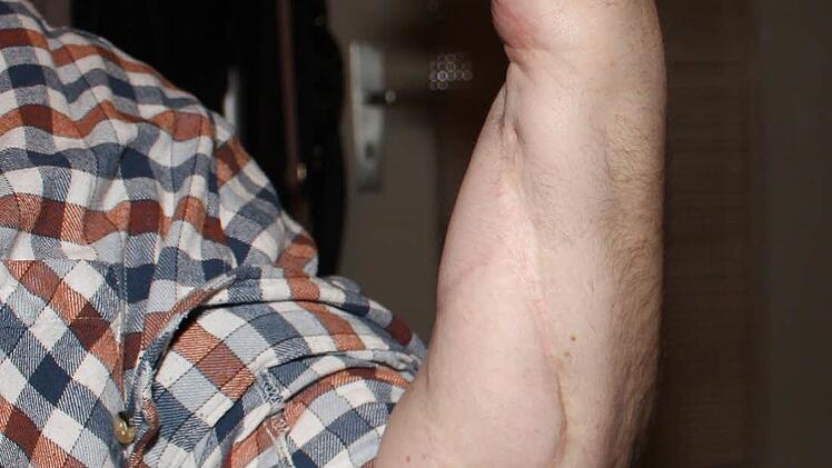 Voll mit Narben, "aber besser als ganz weg” ist der Arm heute. Foto: Evi Seeger