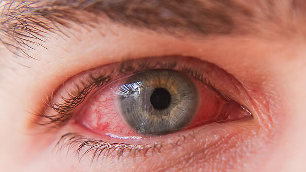 Bindehautentz&uuml;ndung: Das sind Symptome, Ursachen, Behandlungsm&ouml;glichkeiten