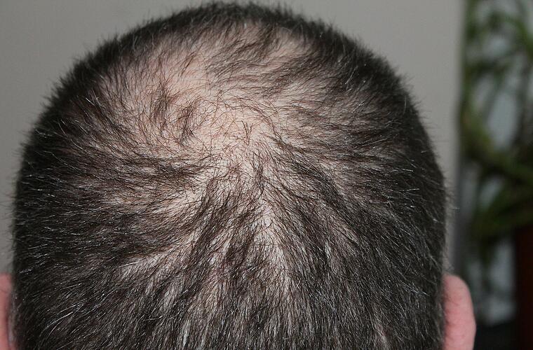 was hilft wirklich gegen haarausfall