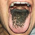 Haarzunge: Bei dem Bewuchs handelt es sich nicht wirklich um Haare, sondern um verlängerte Papillen der Zunge. Schuld sind Antibiotika. Foto: New England Journal of Medicine
