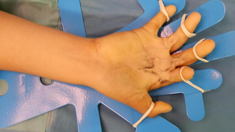Von der geschlossenen zur wieder funktionsfähigen Hand  Foto: Klinikum Kulmbach
