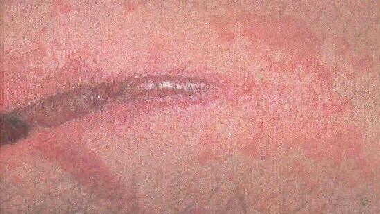 Schwere Verbrennungen und Wunden können durch die Berührung mit der Herkulesstaude entstehen. Foto: privat