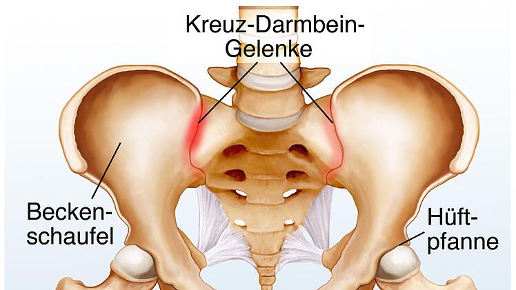 M&ouml;gliche Ursache f&uuml;r Schmerzen im unteren R&uuml;ckbereich: Der Schmerz, den eine Blockade oder Verschiebung des Kreuz-Darmbein-Gelenk ausl&ouml;st,kann  vom Oberschenkel, Po, in die Leistengegend, den Bauch oder sogar bis hin zum Fu&szlig; strahlen. Foto: Adobe Stock