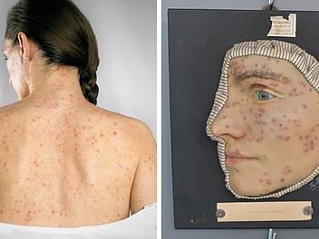 Uniklinikum Erlangen: Syphilis-Erkrankungen in Deutschland steigen "beunruhigend stark"