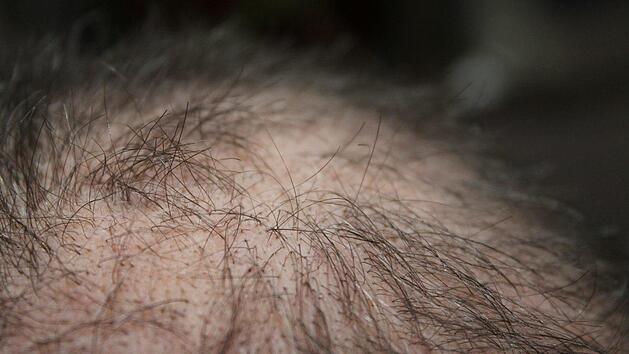 Ein internationales Forscherteam hat ein neues pflanzliches Extrakt aus Erbsenkeimen entwickelt, welches den Haarausfall bei Mann und Frau eindämmen stoppen soll. Symbolbild: pixabay.com/kalhh