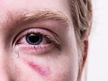 Am Montagnachmittag (3.12.2018) haben Unbekannte einen 64-jährigen Mann im Nürnberger Stadtteil Pillenreuth überfallen und ihm eine unbekannte Flüssigkeit ins Gesicht geschüttet. Symbolfoto: Pixabay/Anemone123