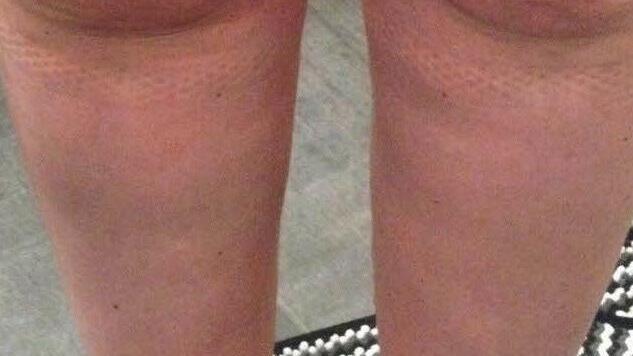 So sahen die Beine von Nicole Herrmann vor der Operation aus. Foto: privat