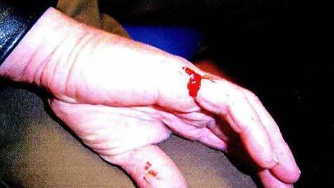 Diese Bisswunde musste ein Höchstadter Polizeibeamter behandeln lassen.  Foto: Polizei