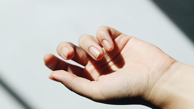 Brüchige Nägel können ein Hinweis auf einen Kalziummangel sein.