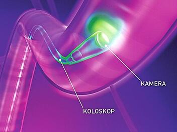 Bei einer Darmspiegelung wird der Darm mit einem Endoskop von innen betrachtet.  Skizze: Felix-Burd-Stiftung