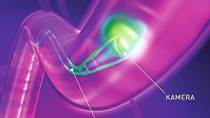 Bei einer Darmspiegelung wird der Darm mit einem Endoskop von innen betrachtet.  Skizze: Felix-Burd-Stiftung