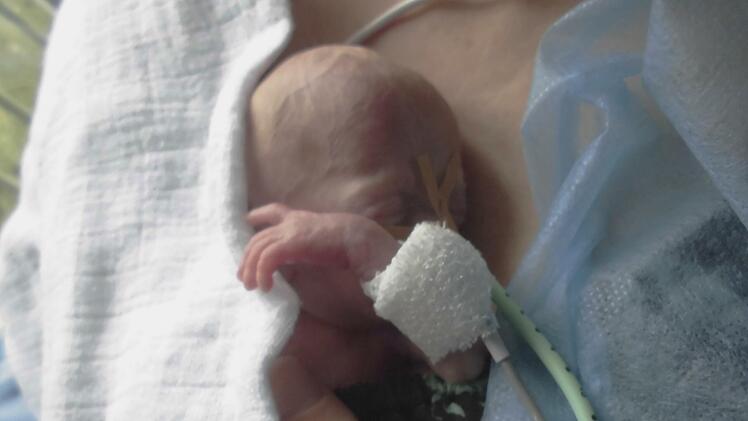 Das Extrem-Frühchen Sophia, zum ersten Mal auf der Brust ihrer Mama als sie etwa zehn Tage alt war.