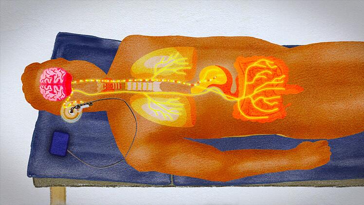 Mit elektrischen Reizen kann man das Nervensystem gezielt stimulieren.