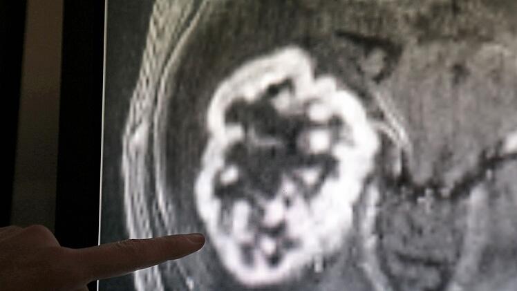Die Diagnose Krebs ist oft ein schwerer Schlag