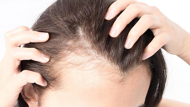 Erlanger Forscher entwickeln Wirkstoff gegen Haarausfall