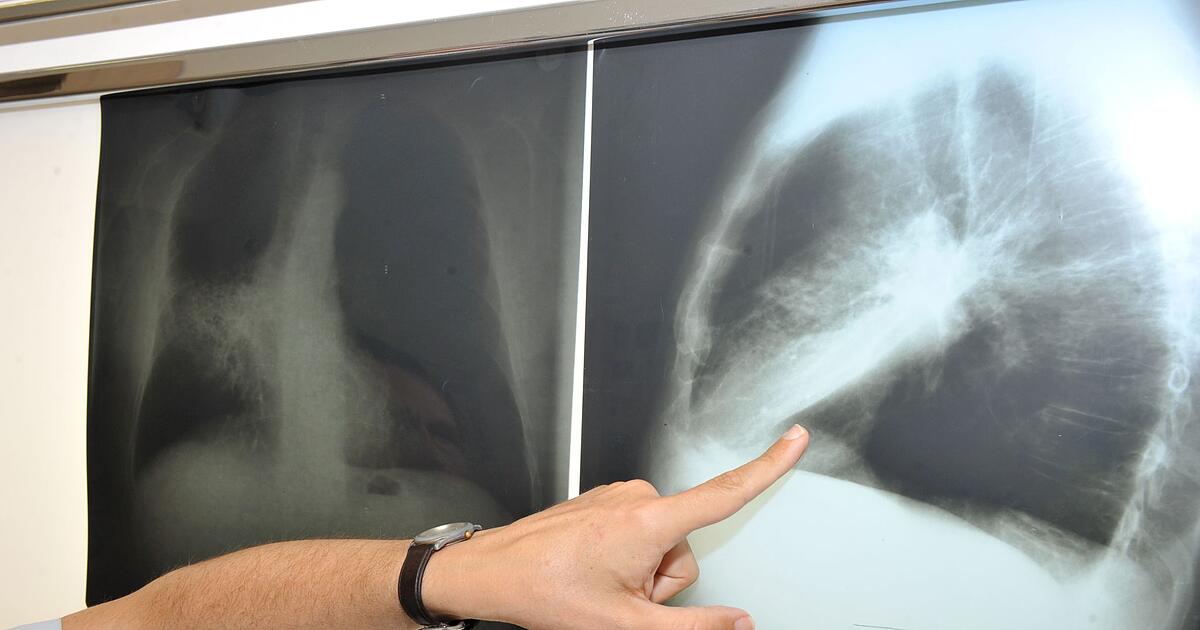 Altersstandardisierte-Krebsmortalit-t-in-Deutschland-sinkt