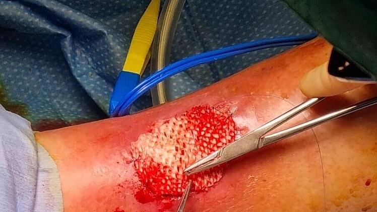 Fischhaut zur Behandlung von gro&szlig;en Wunden