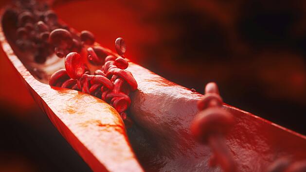 Arteriosklerose, Erkrankungen der arteriellen Blutgefäße, 3D, Herzinfarkt, Schlaganfall, Blut, Verstopfte Arterien, Cholesterin, Herz-Kreislauf-Erkrankungen