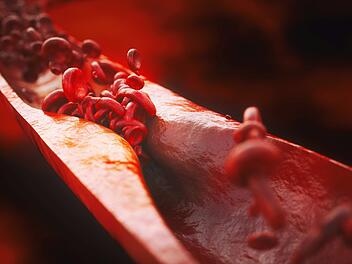 Arteriosklerose, Erkrankungen der arteriellen Blutgefäße, 3D, Herzinfarkt, Schlaganfall, Blut, Verstopfte Arterien, Cholesterin, Herz-Kreislauf-Erkrankungen