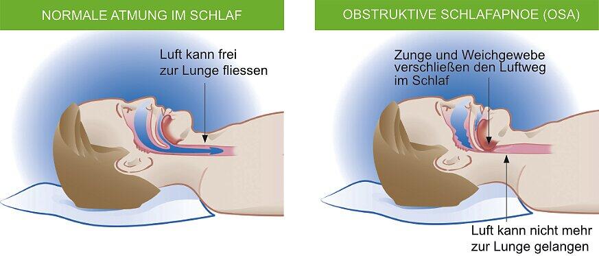 Wie Viele Atemaussetzer Sind Normal www.infranken.de