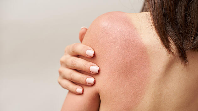 Sonnenbrand, Hautr&ouml;tung, Sonnencreme, Hautkrebs