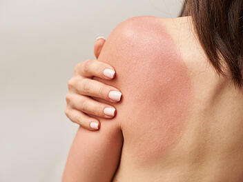 Sonnenbrand, Hautrötung, Sonnencreme, Hautkrebs