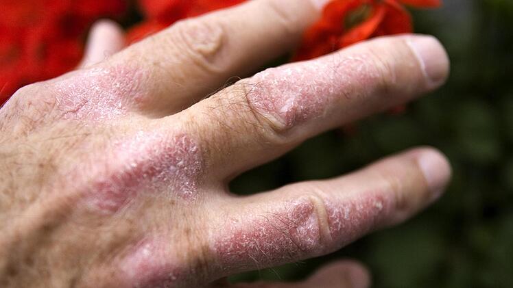 Uniklinik Erlangen informiert über Schuppenflechte - Vorträge und Gesprächsrunde