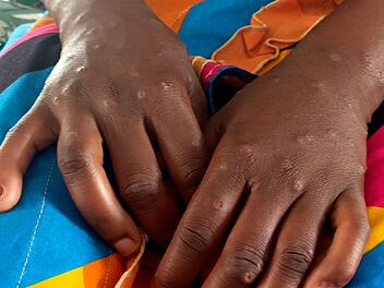 Mpox
