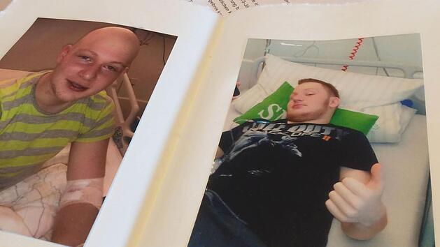 Benedikt Fehd hat seine Haare bei der Chemotherapie verloren. Langsam wachsen sie wieder und es geht aufw&auml;rts. Foto: Christiane Lehmann