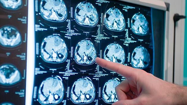 Schlaganfall-Studie mit erschreckenden Ergebnissen